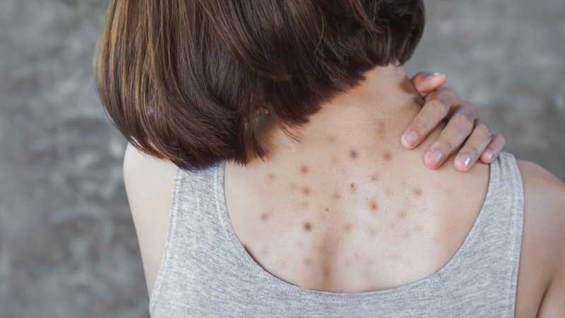 Có nhiều nguyên nhân gây ra mụn lưng